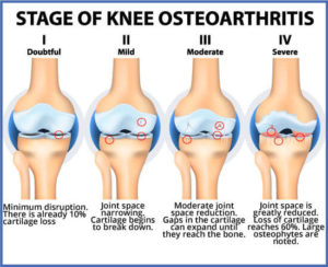 stages of osteoarthritis